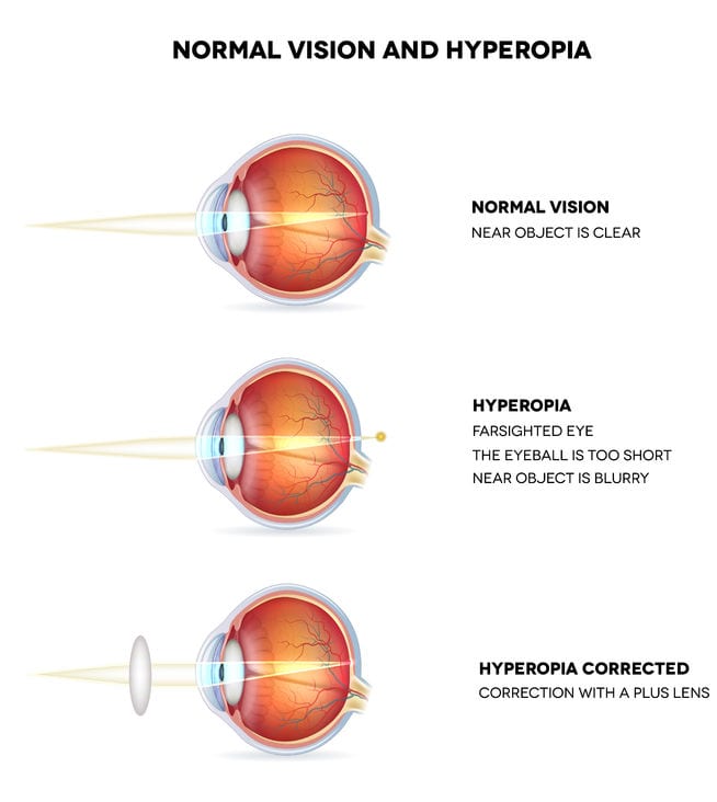 Eye and Vision Conditions