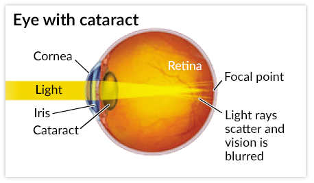 cataract vision night